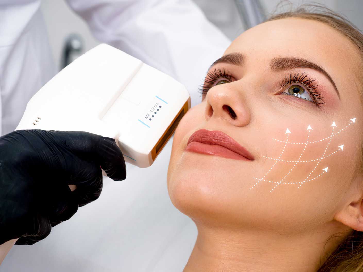 Acne Scars Explained: Why Deep Treatments Work Better Than Creams-GLM Beauty Spa Equipment Factory