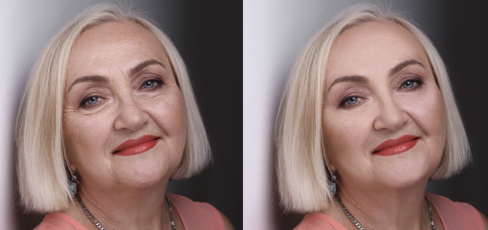 Facelift or Not? Exploring Alternatives to Facial Rejuvenation