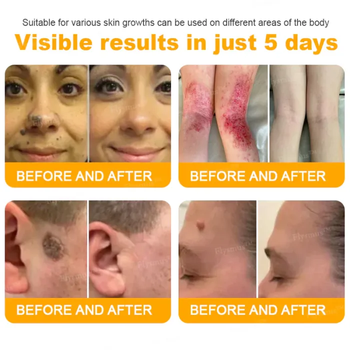👨‍⚕️✅Pain-free flysmus® Bee Venom Wart-Removal Repair Cream—Made for all skin types (🔥Buy 1 Get 1 Free🔥)