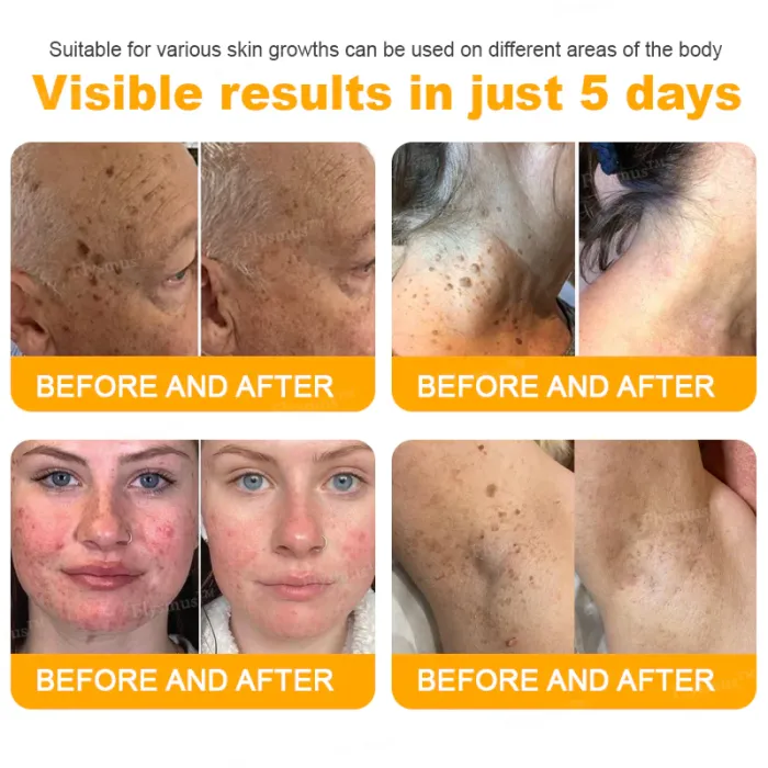 👨‍⚕️✅Pain-free flysmus® Bee Venom Wart-Removal Repair Cream—Made for all skin types (🔥Buy 1 Get 1 Free🔥)