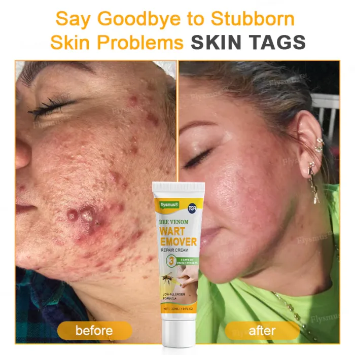 👨‍⚕️✅Pain-free flysmus® Bee Venom Wart-Removal Repair Cream—Made for all skin types (🔥Buy 1 Get 1 Free🔥)