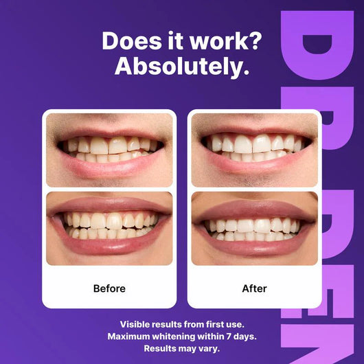 Broochtin™ Purple Tooth Whitening Strips