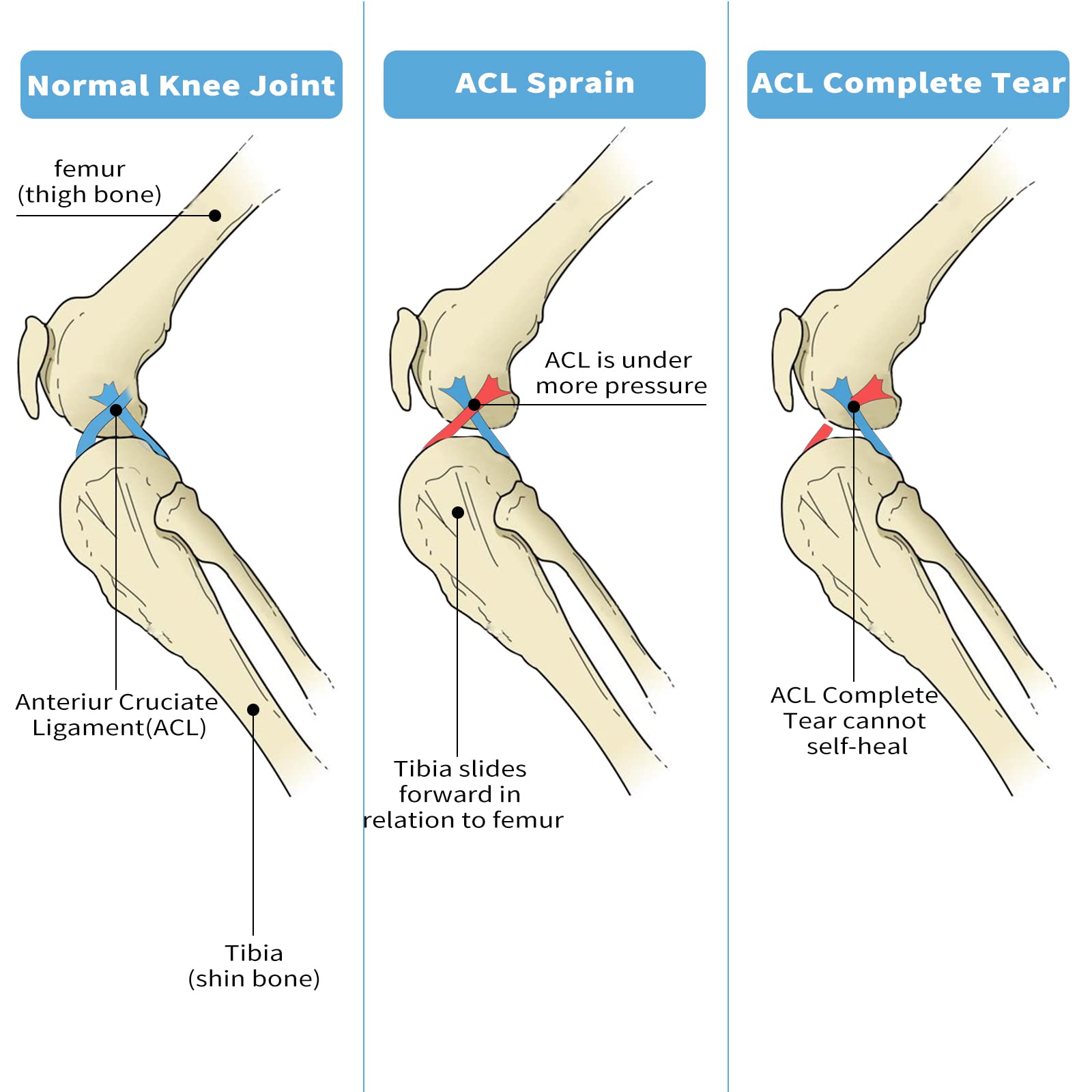 Dog Knee Brace, Dog Leg Brace for Sprain ACL, CCL, Arthritis
