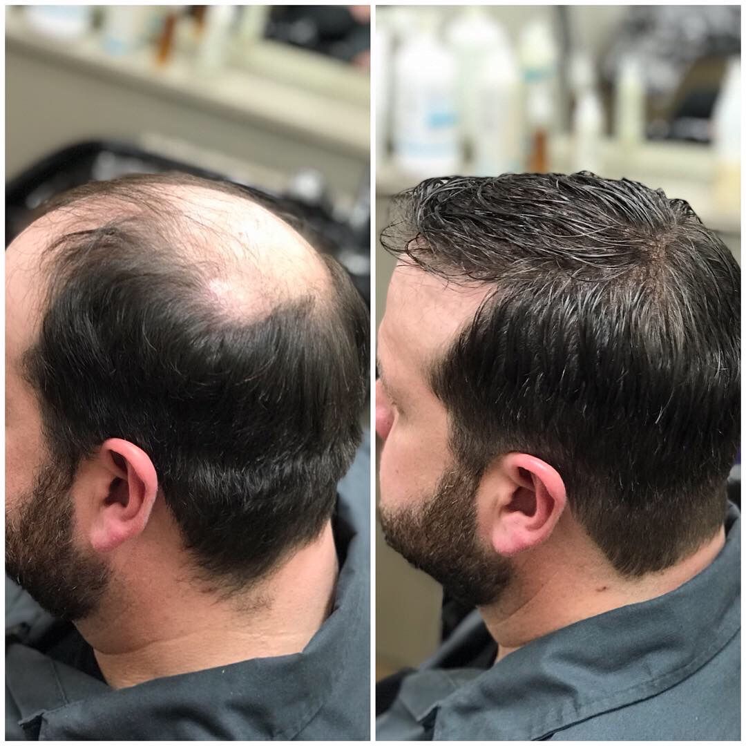 Hairskeen Men's Hair Loss Transformation | Hair loss men, Reduce hair ...