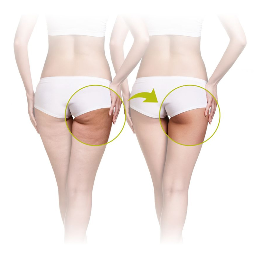 Lanaform Skin Mass Anti-Cellulite Massager