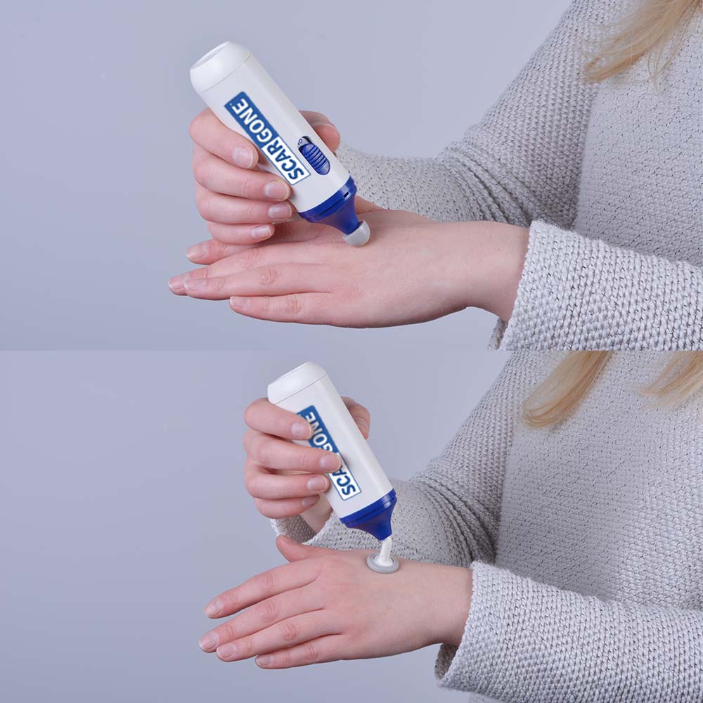 ScarGone™ Scar Management Massager & Balm Set 