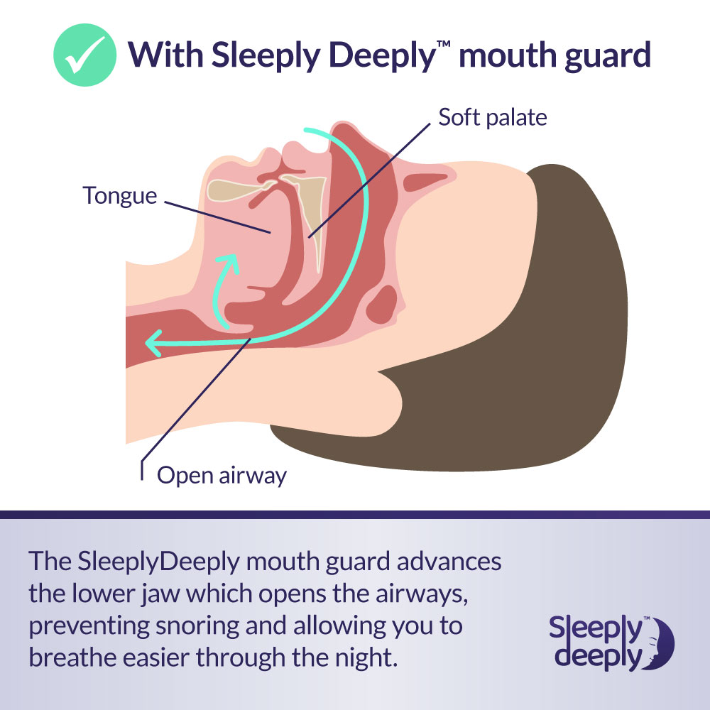 Sleeply Deeply Male Anti Snoring EasyFit Mouth Guard 7