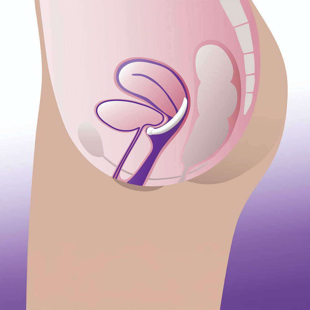 Illustration showing the iDish incontinence pessary positioned inside the vagina, supporting the urethra and bladder to help manage stress urinary incontinence and provide pelvic organ prolapse support.