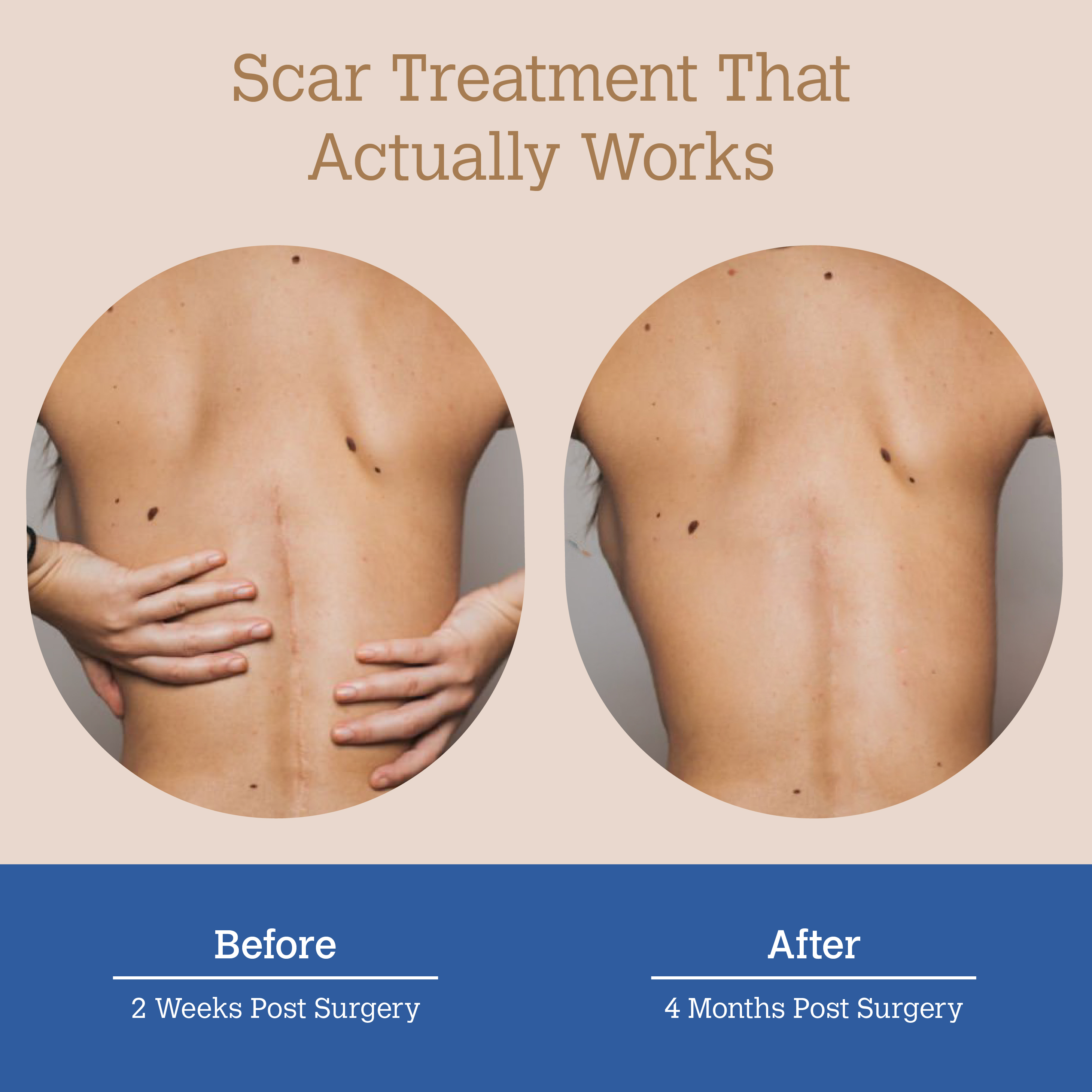 ScarGone Silicone Scar Therapy Sheets