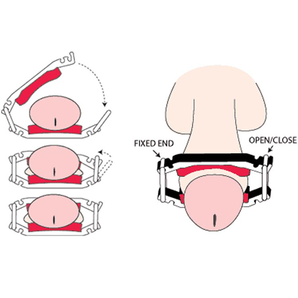 Dribblestop - Male Urinary Incontinence Clamps x 2 4