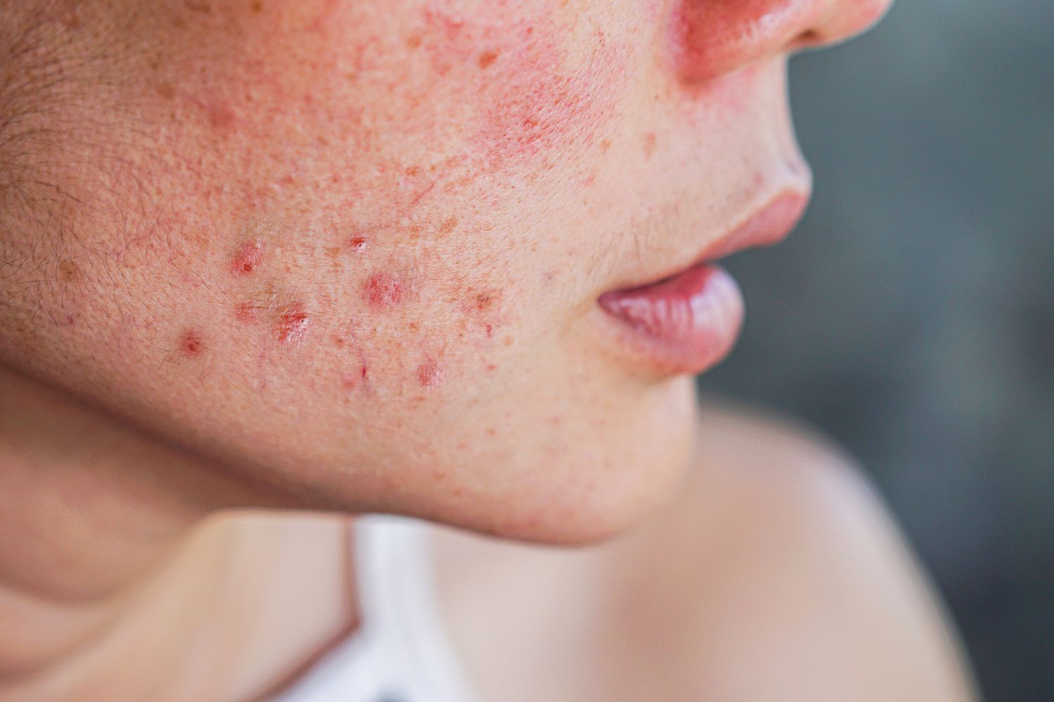 Side view of a face with visible acne and redness, representing skin concerns explored in content about vitamin D and its potential benefits for acne-prone skin. Can Vitamin D be the Secret to Acne-Free Skin?-StressNoMore