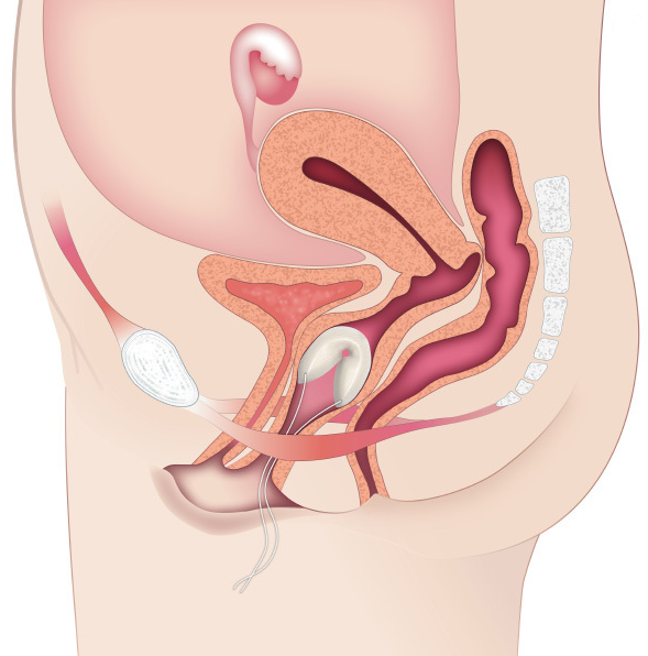 Contrelle Activgard Bladder Support for Incontinence Relief