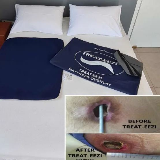 Clinically Approved Pressure Sore Relieving Bed Overlay