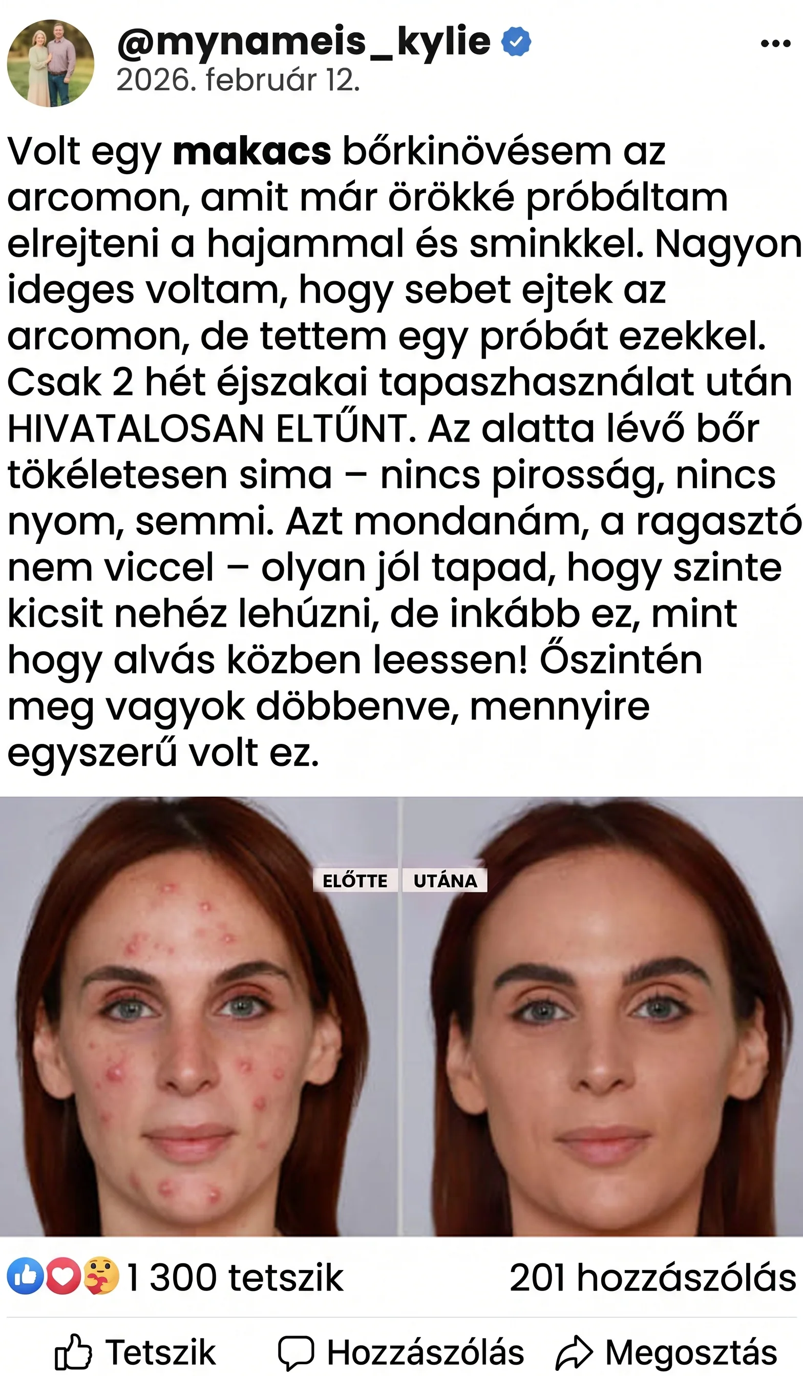 ✨ PuraCure® 2 az 1-ben mikrotűs és hidrokolloid tapasz🍀 | Kiálló anyajegyek, aknék, lapos szemölcsök és bőrnövedékek eltávolítására | Segít csökkenteni a ráncokat, hegeket és bőrhibákat | Láthatatlan tapasz az arcra és testre