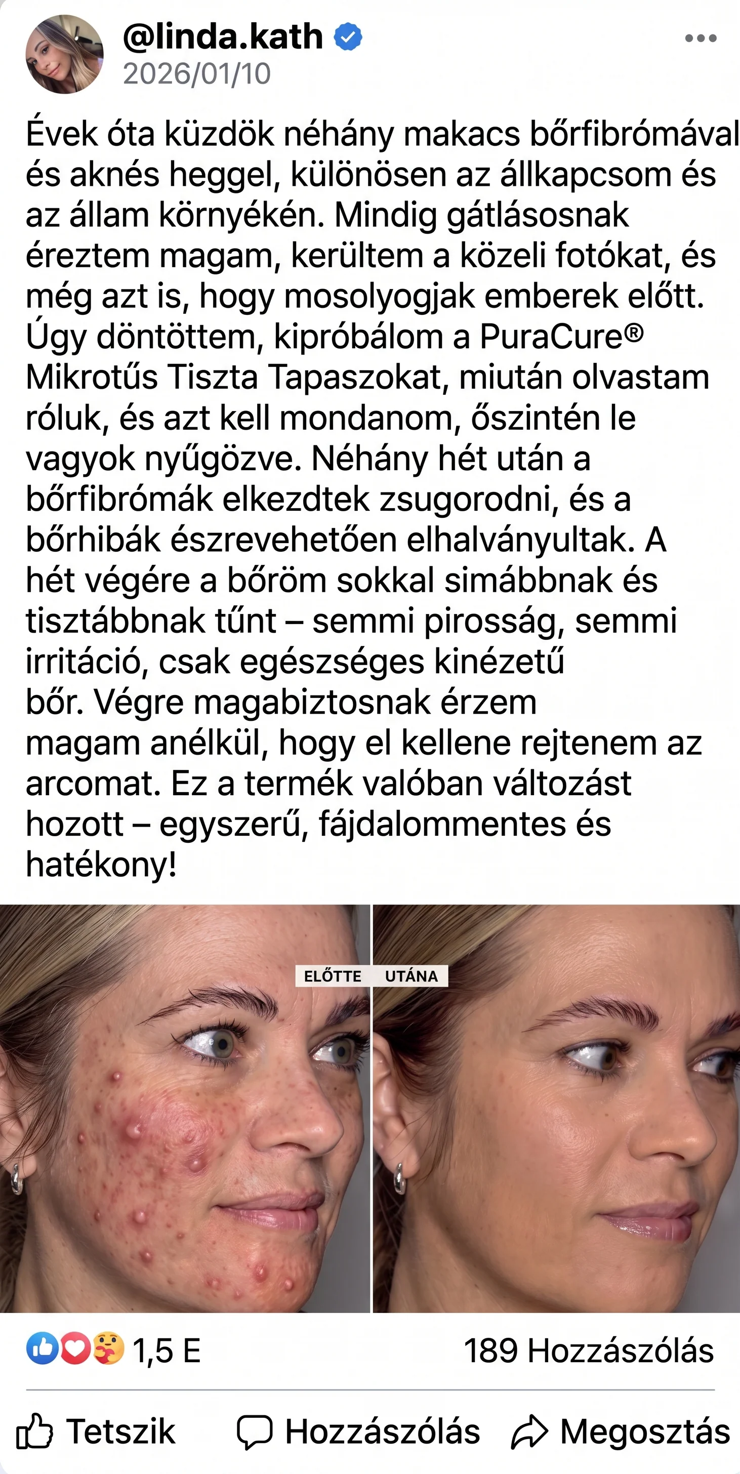 ✨ PuraCure® 2 az 1-ben mikrotűs és hidrokolloid tapasz🍀 | Kiálló anyajegyek, aknék, lapos szemölcsök és bőrnövedékek eltávolítására | Segít csökkenteni a ráncokat, hegeket és bőrhibákat | Láthatatlan tapasz az arcra és testre