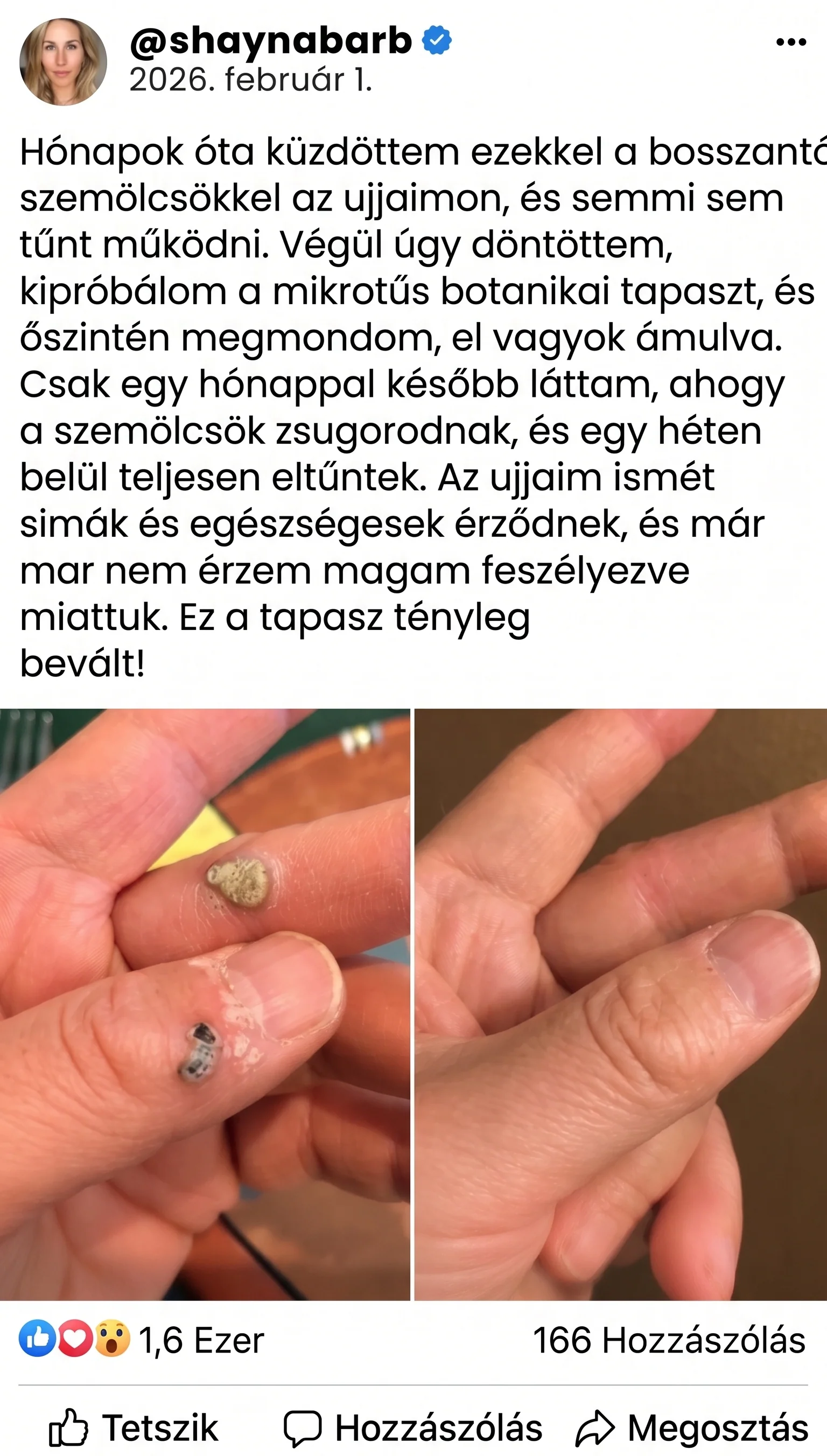 ✨ PuraCure® 2 az 1-ben mikrotűs és hidrokolloid tapasz🍀 | Kiálló anyajegyek, aknék, lapos szemölcsök és bőrnövedékek eltávolítására | Segít csökkenteni a ráncokat, hegeket és bőrhibákat | Láthatatlan tapasz az arcra és testre