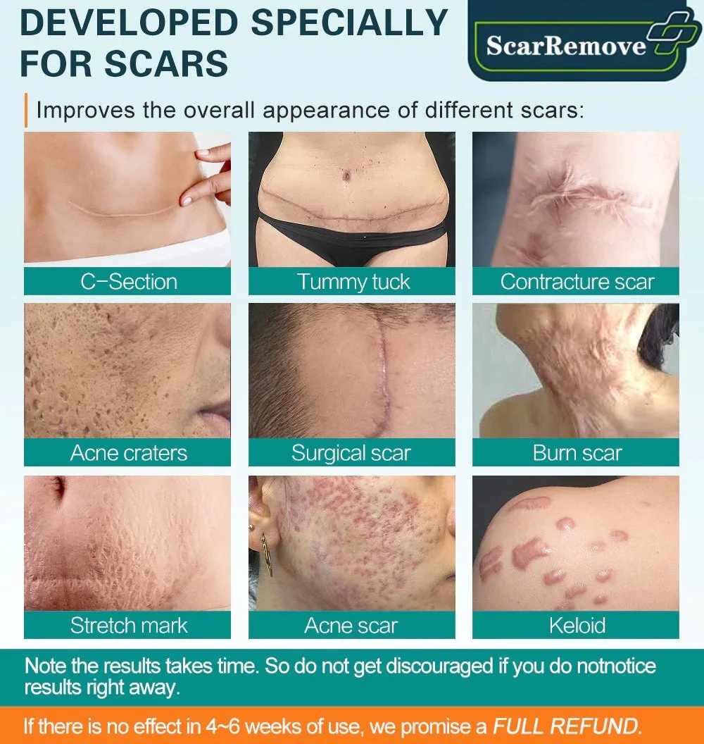 ❤️ScarRemoveTM Advanced Scar Spray For All Types of Scars - For example Acne Scars, Surgical Scars and Stretch Marks ⚡️⚡️⚡️