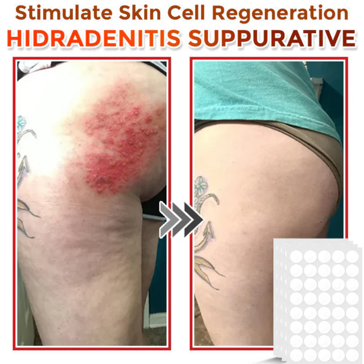 Taimsed papilloomi eemaldamise plaastrid