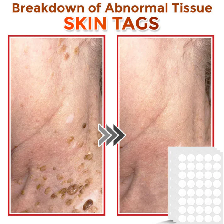 Taimsed papilloomi eemaldamise plaastrid