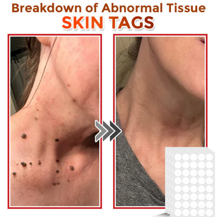 Taimsed papilloomi eemaldamise plaastrid