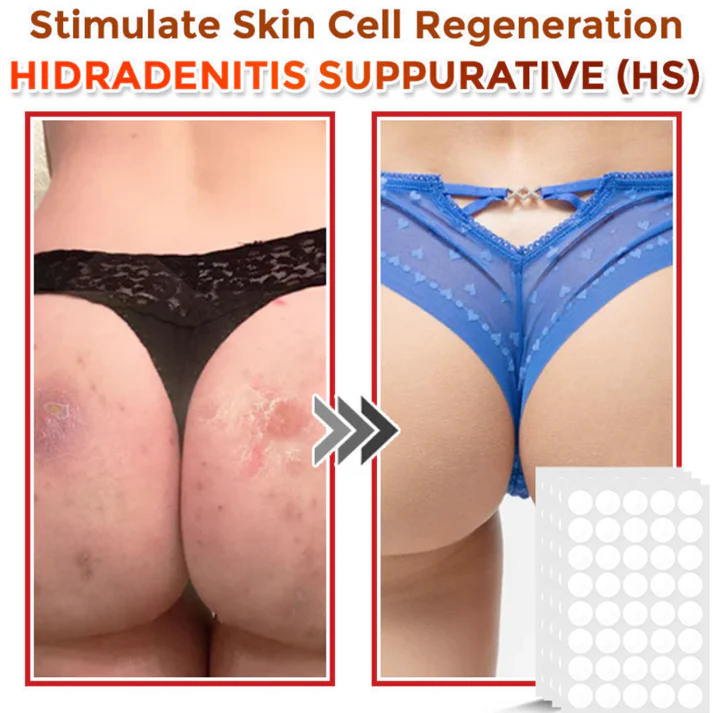 Taimsed papilloomi eemaldamise plaastrid