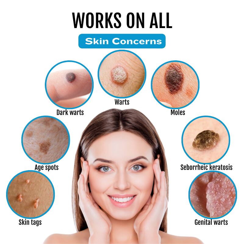 Bikenda SpotlessDerm Mole and Wart Laser Pen