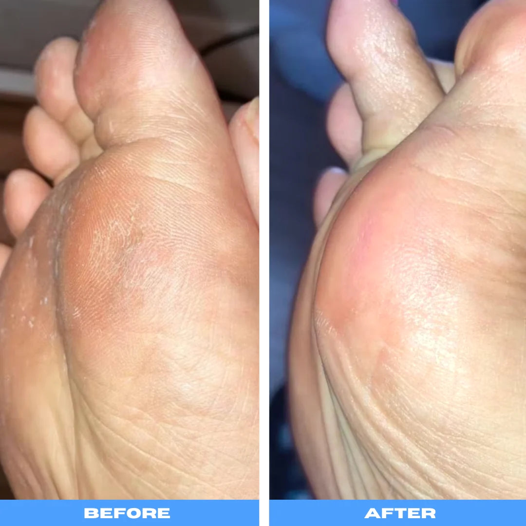 PediVac™ | Electric Callus Remover With Vacuum