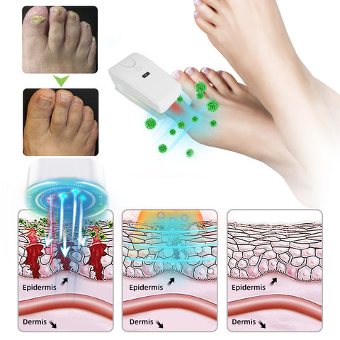 Laser nail fungus treatment device Furzero™ Max Plus