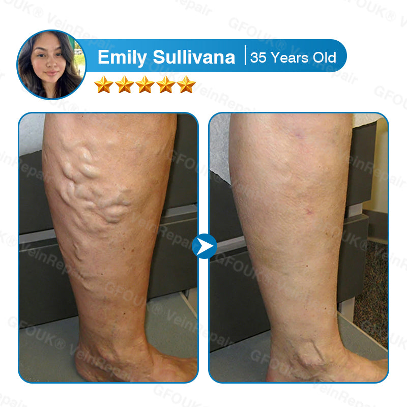 VeinRepair Microneedle Patch Roll⚡Instant Relief, Long-Term Results