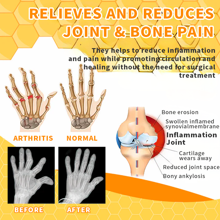 (🔥Limited Time Discount 🔥 Last Day🔥) 🐝AQA™ Bee Venom Joint Therapy Pain Relief Gel