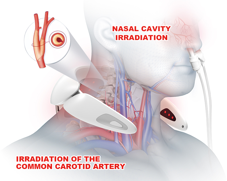 Semiconductor laser therapy device - treatment of neck, rhinitis, cardiovascular and cerebrovascular diseases