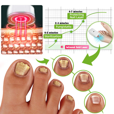 Laser nail fungus treatment device Furzero™ Max Plus