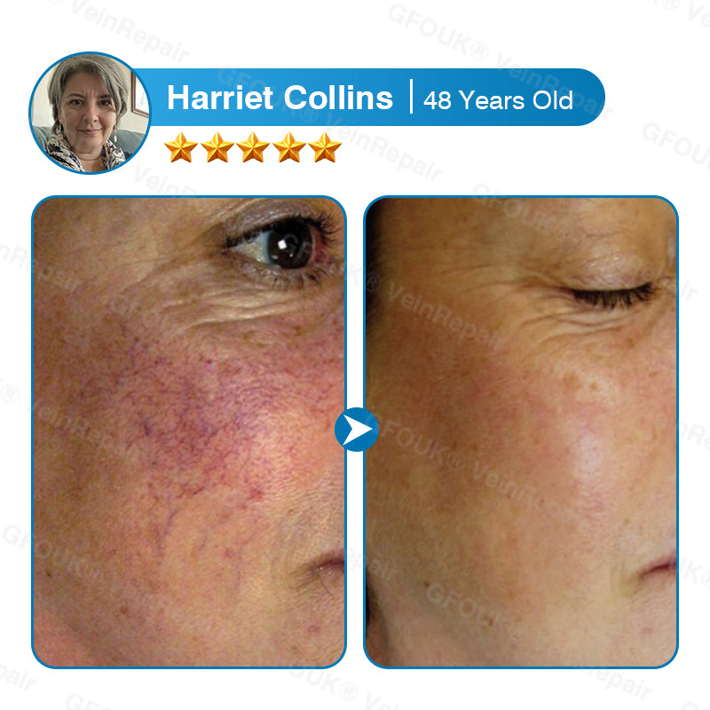 VeinRepair Microneedle Patch Roll⚡Instant Relief, Long-Term Results