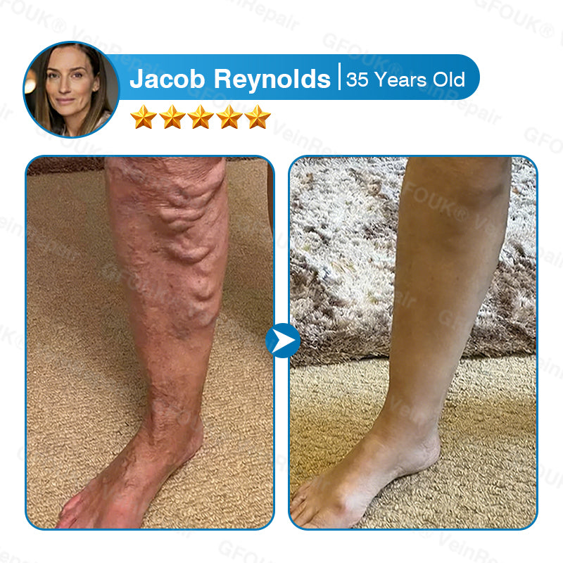 VeinRepair Microneedle Patch Roll⚡Instant Relief, Long-Term Results