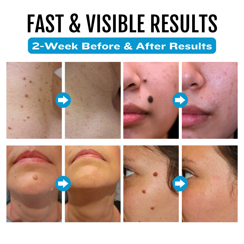 Bikenda SpotlessDerm Mole and Wart Laser Pen