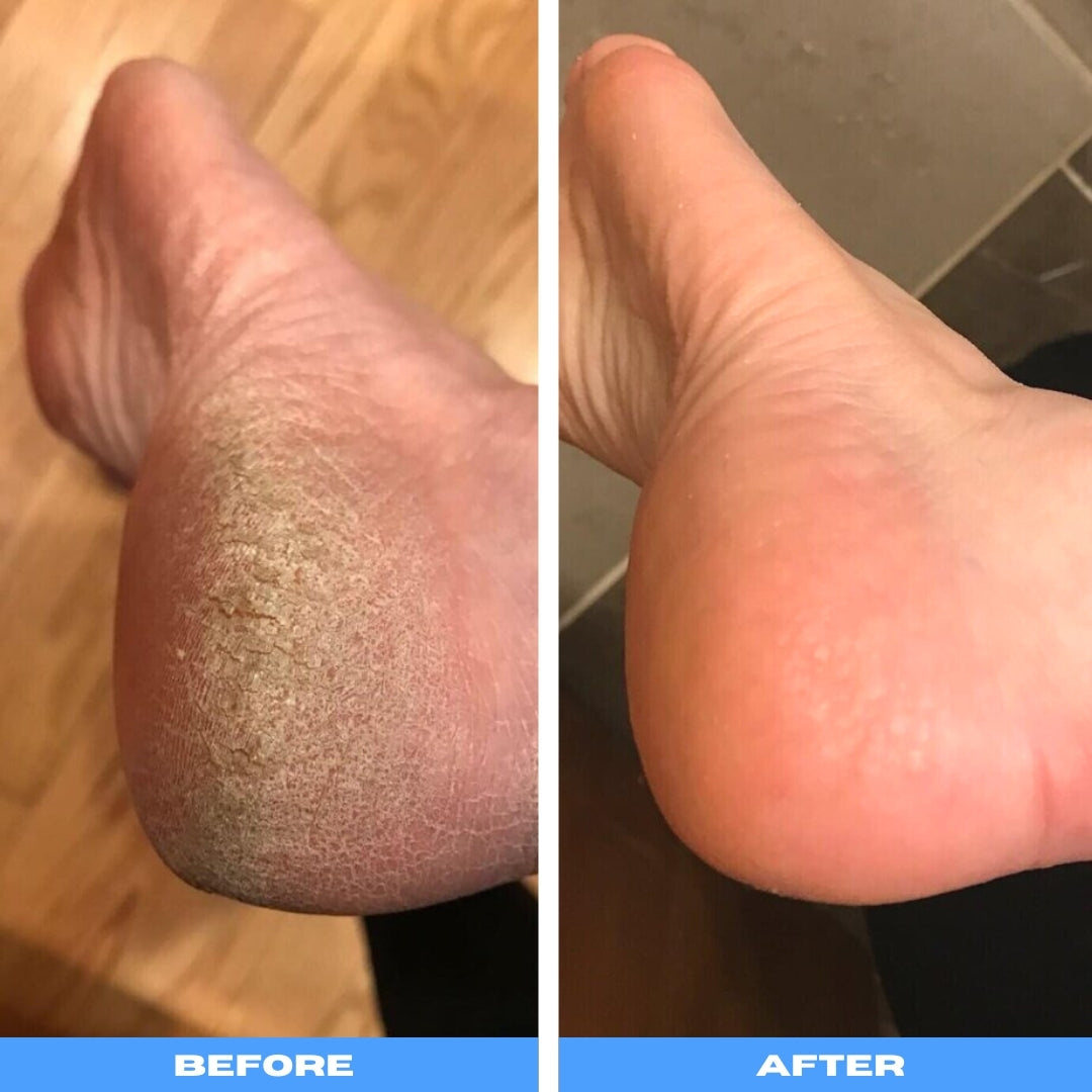 PediVac™ | Electric Callus Remover With Vacuum