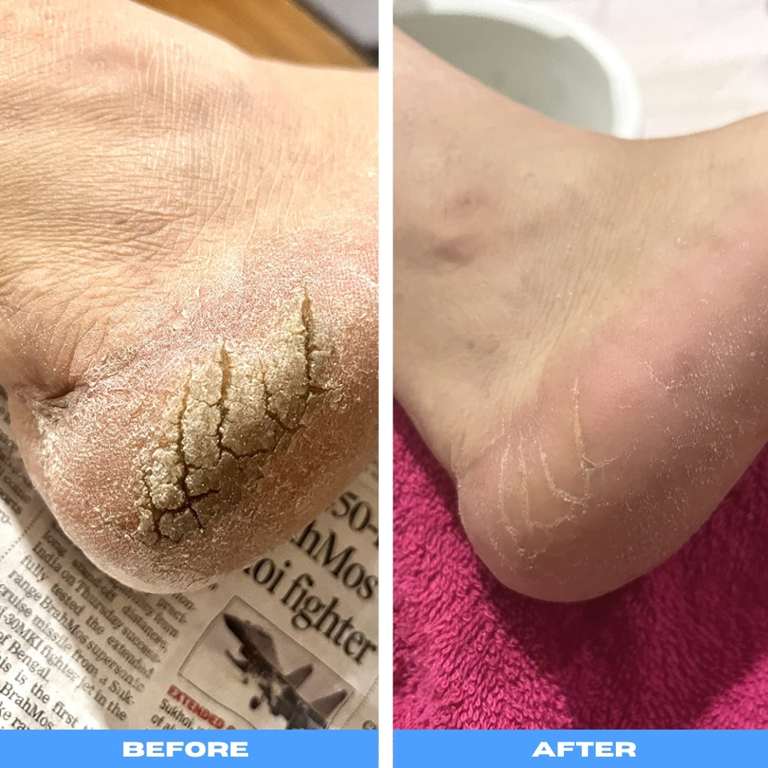 PediVac™ | Electric Callus Remover With Vacuum