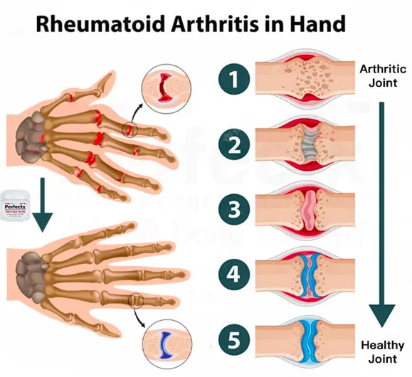 (Buy 1, Get 2 Free, Full Refund If No Visible Results Within 3 Weeks) BeeVenom™ New Zealand Professional Bee Venom Treatment Gel