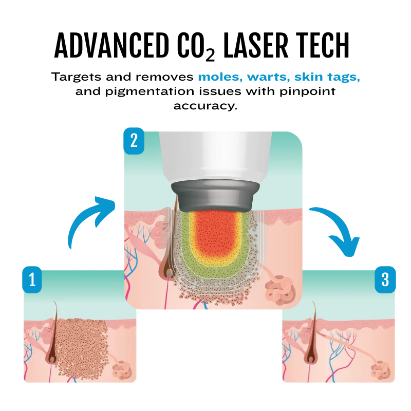 Bikenda SpotlessDerm Mole and Wart Laser Pen