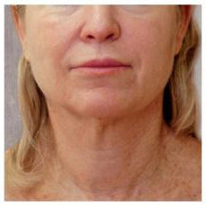 ✨Last Day Promotion 49% OFF - B5Botox Face Serum