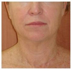 ✨Last Day Promotion 49% OFF - B5Botox Face Serum