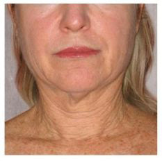 ✨Last Day Promotion 49% OFF - B5Botox Face Serum