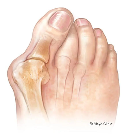 Comprehensive Guide to Choosing the Best Orthopedic Shoes for Bunions-GARB 