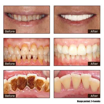 ✨ Achieve a Radiant Smile - 49% OFF - 🦷 Niacinamide Whitening Toothpaste - For Healthier, Whiter Teeth!