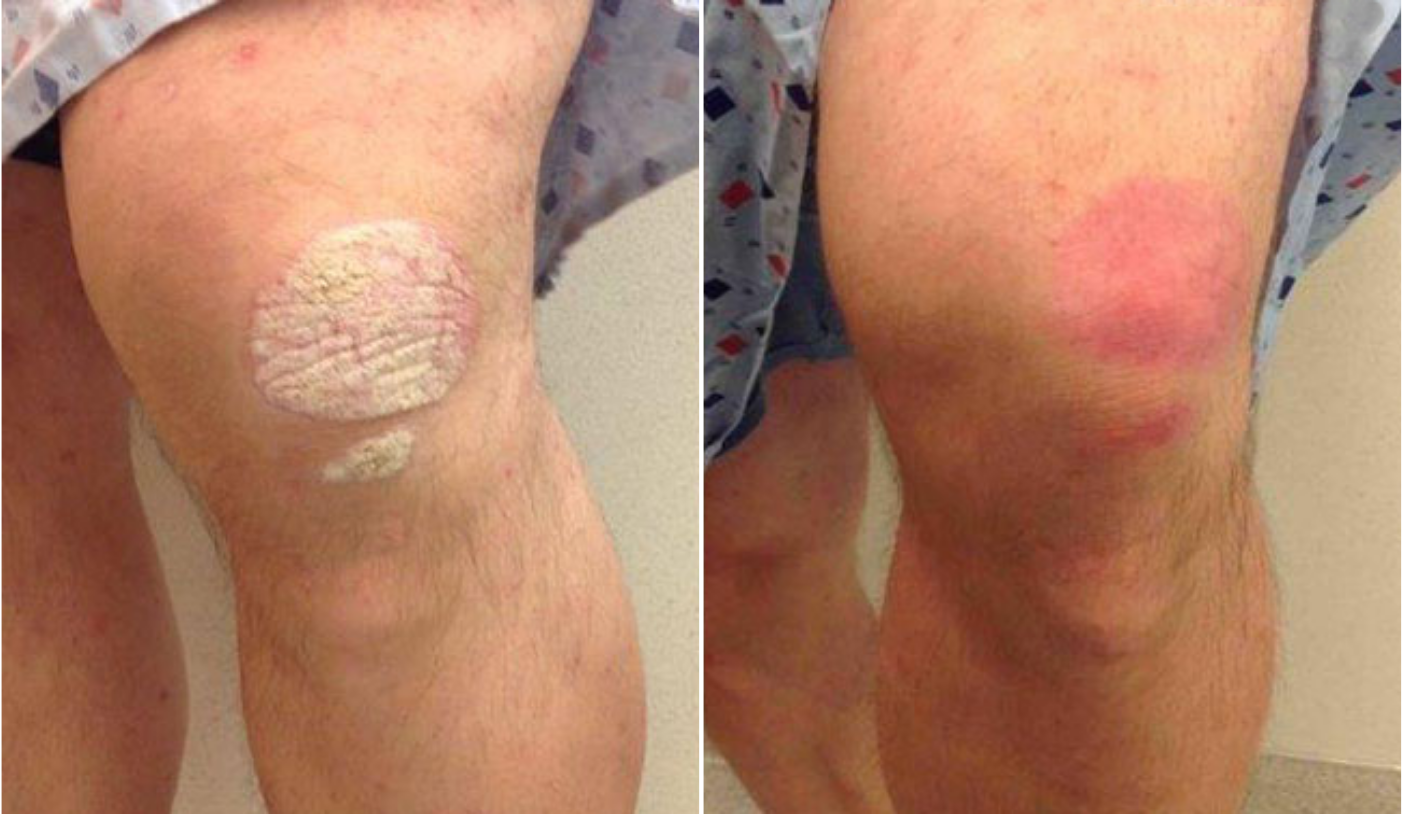 Psoriasis - Before & Afters
