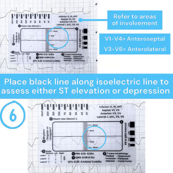ECG 7 Step Ruler