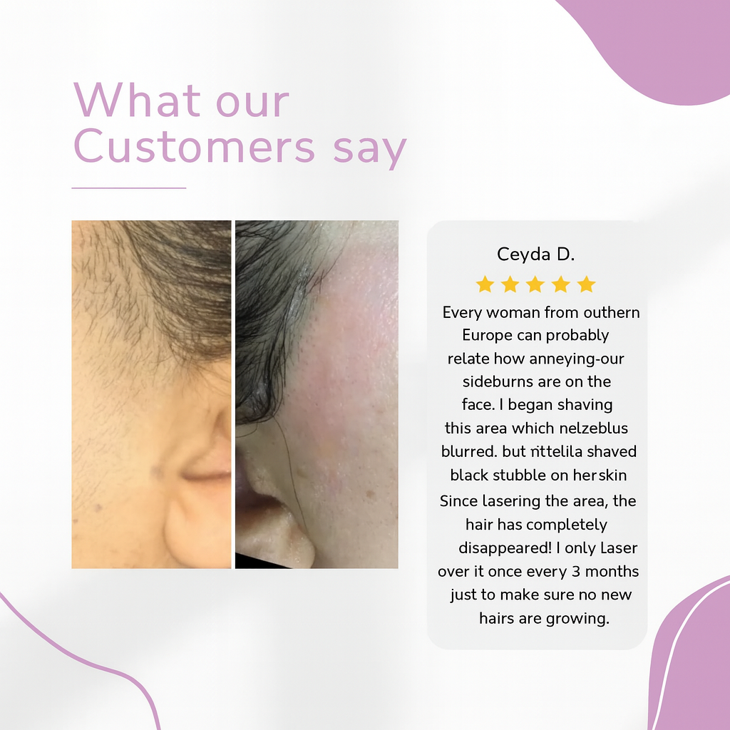 Αποτριχωτική συσκευή Ylvis IPL – Λείο, χωρίς τρίχες δέρμα από το σπίτι