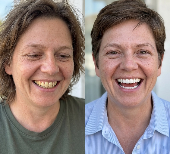Verified user with a brighter, whiter smile after using Asuno