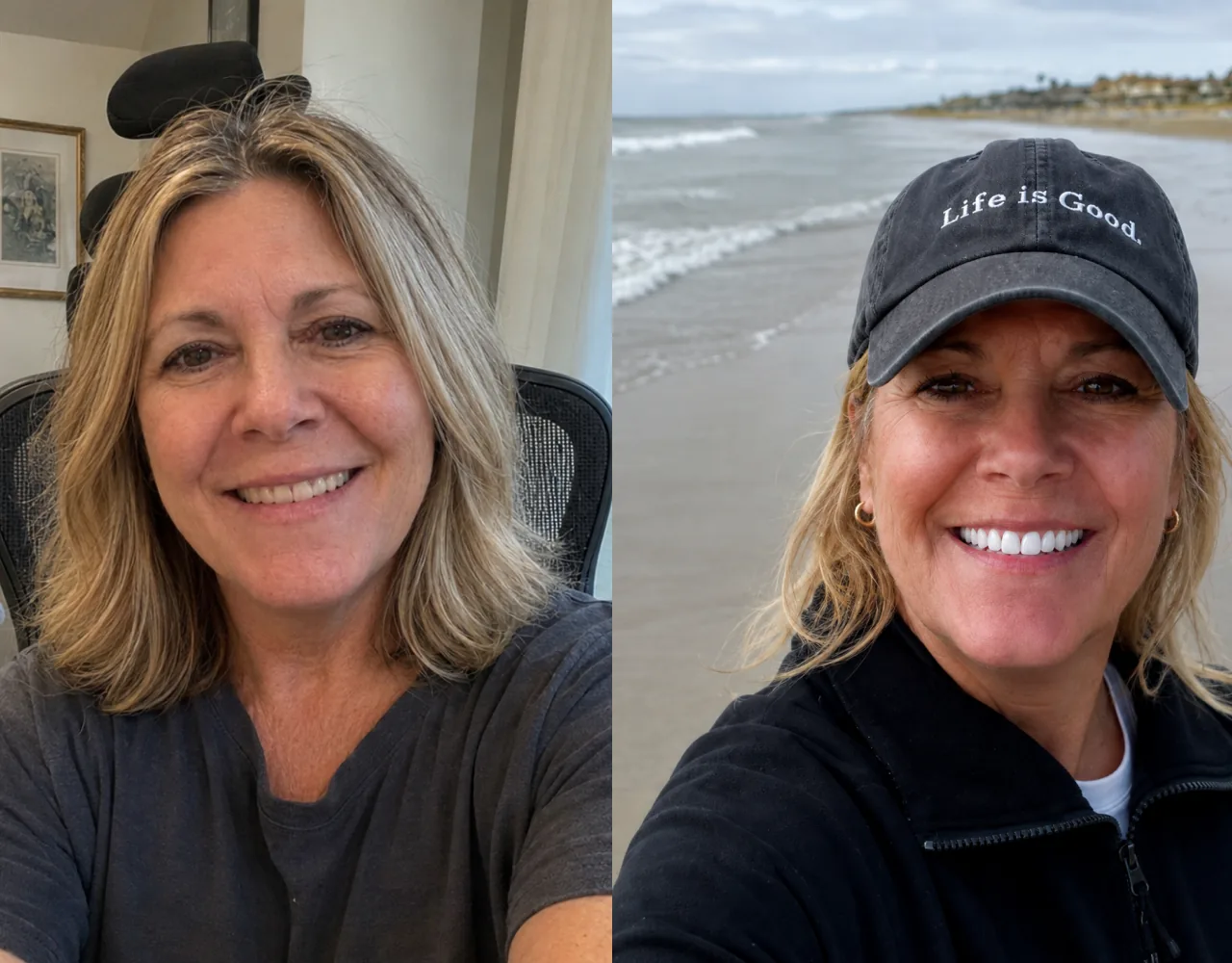 The same person's teeth before whitening on day 1 and noticeably whiter on day 7