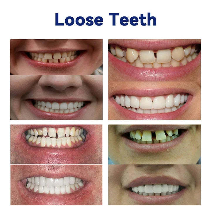 New Generation Flexible Full Denture Solution